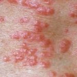 საპანიკო არაფერია – პაატა იმნაძე ქვეყანაში მუნის გავრცელებაზე